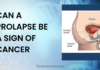 Can A Prolapse Be A Sign Of Cancer Can A Prolapse Be A Sign Of Cancer