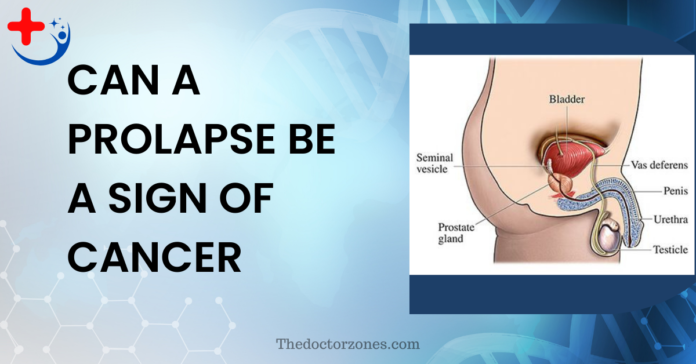 Can A Prolapse Be A Sign Of Cancer
