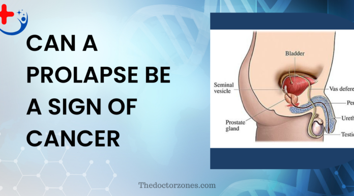 Can A Prolapse Be A Sign Of Cancer Can A Prolapse Be A Sign Of Cancer