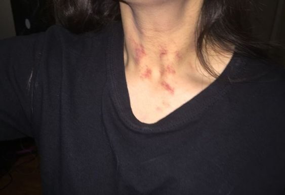 Do Hickeys Cause Cancer: Do hickeys cause tumors Do Hickeys Cause Cancer