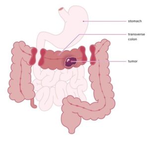 bowel cancer stomach noises