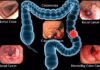 Bowel Cancer Stomach Noises: Bowel Cancer Symptoms bowel cancer stomach noises