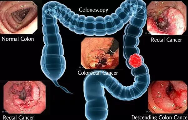 Bowel Cancer Stomach Noises: Bowel Cancer Symptoms bowel cancer stomach noises