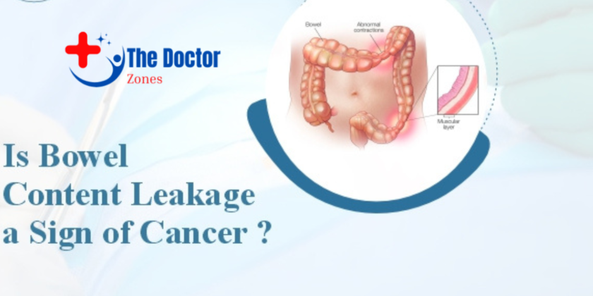 Is Bowel Leakage a Sign of Cancer: Bowel leakage causes - thedoctorzones