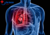 Lung Cancer ICD-10: Decoding the Precision in Healthcare Lung Cancer ICD-10