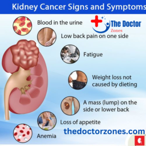 How I Found Out I Had Kidney Cancer