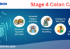 Stage 4 Colon Cancer: Stage 4 colon cancer life Stage 4 Colon Cancer