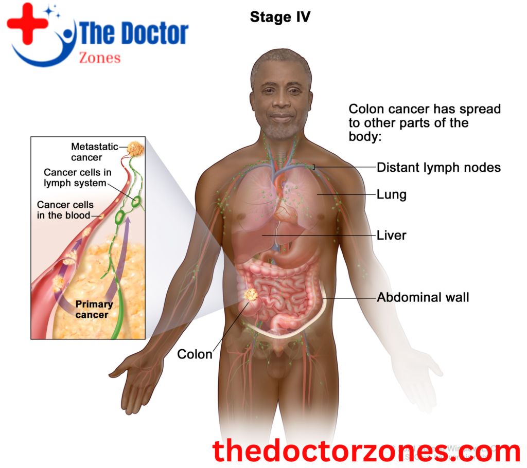 Stage 4 Colon Cancer