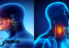 Head and Neck Cancer Treatment: Navigating the Path to Recovery Head and Neck Cancer Treatment