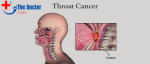 What Causes Throat Cancer