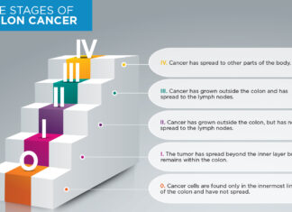 Stage 4 Colon Cancer Survival Rate: Navigating Hope Amidst Challenges Stage 4 Colon Cancer Survival Rate