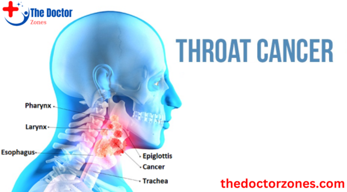 What Causes Throat Cancer: Throat cancer – Symptoms and causes What Causes Throat Cancer